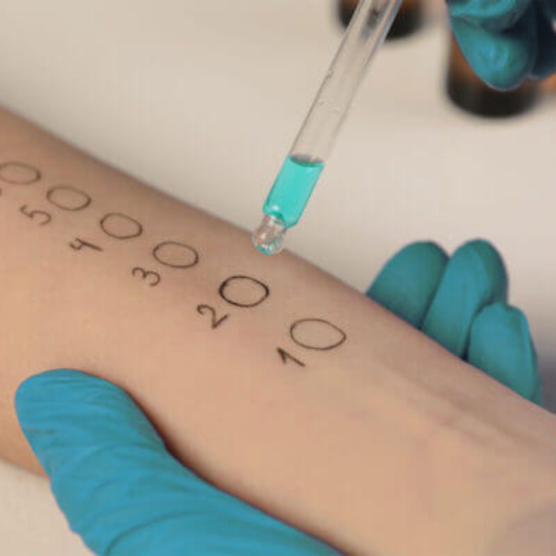 Allergietest am Unterarm mit markierten Teststellen