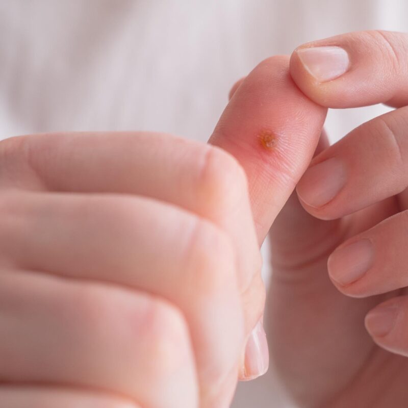 A,Skin,Growth,On,The,Hand,,A,Wart,Caused,By